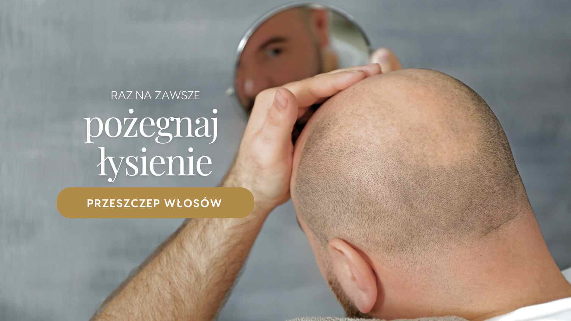 Marina MedEstetic | Przeszczep włosów - Warszawa Marina MedEstetic | Przeszczep włosów - Warszawa